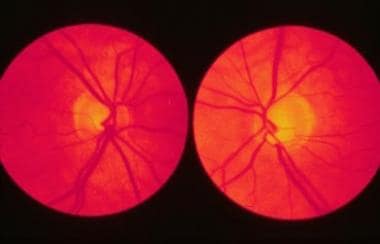 Optic nerve asymmetry in a patient with glaucomato
