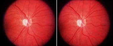 Sectorial optic atrophy of the right eye as a late