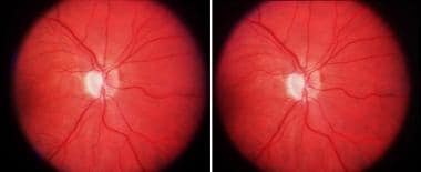 ischemic optic neuropathy