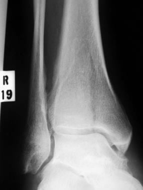 Low-energy pilon fracture in distal tibia with no 