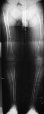 Radiograph shows alignment of the lower extremitie