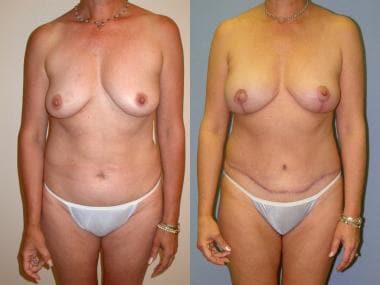 Before and after right skin-sparing mastectomy for