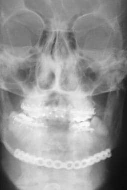 Mandibular fracture. Infection treated with incisi