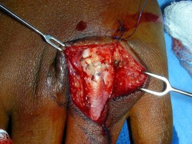 Primary closure of thumb extensor tendon laceratio