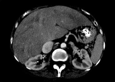 Cardiac cirrhosis and congestive hepatopathy. Cong