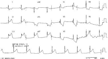 myocardial infarction patient