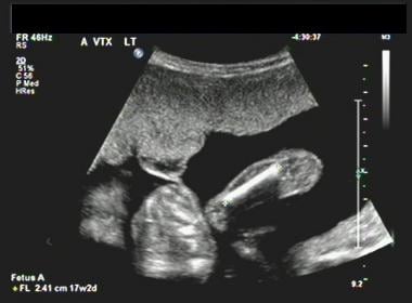 Twin pregnancy ultrasound images