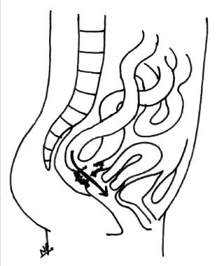 Enterovaginal fistula. 