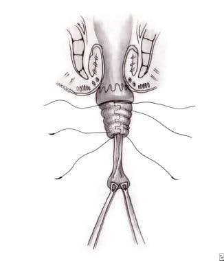 Unwanted Porn Enemas Drawings - Rectal Prolapse Treatment & Management: Approach ...