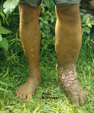 Filariasis. Unilateral left lower leg elephantiasi