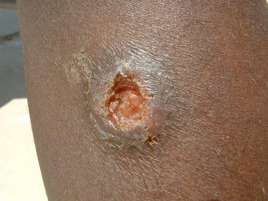 Classic Leishmania major lesion from a case in Ira