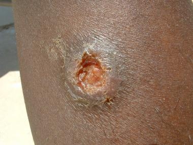 Leishmaniasis: Practice Essentials, Background, Pathophysiology