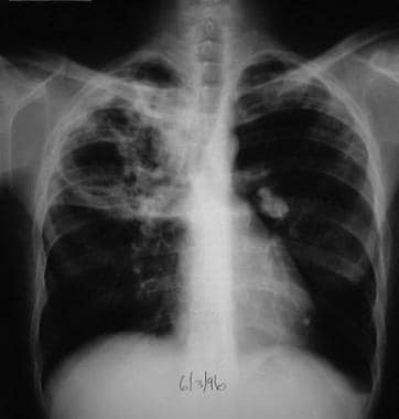 What Is The Role Of Chest Radiography In The Diagnosis Of Tuberculosis Tb