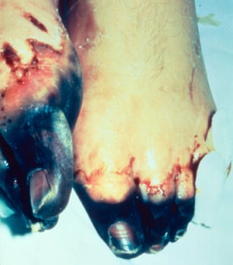 Acral necrosis of the toes and residual ecchymoses