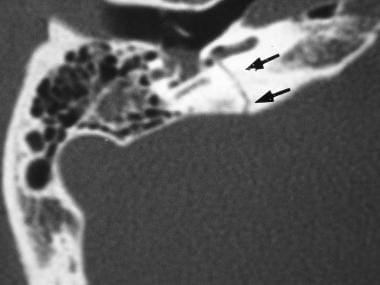 Transverse temporal bone fracture (courtesy of Ada