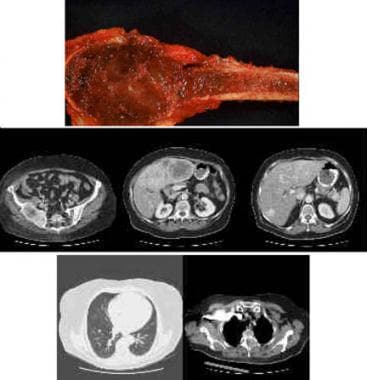 Angiosarcoma: Practice Essentials, Pathophysiology, Etiology