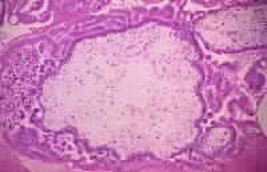 Histologic section of a complete hydatidiform mole