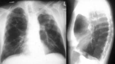 Emphysema. This chest radiograph shows hyperinflat