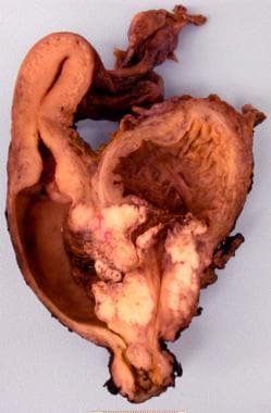 Bladder cancer. Cross-section through the bladder,