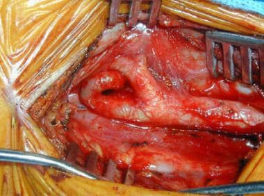 Carotid artery exposed prior to carotid endarterec