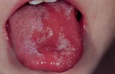 chemical burn mouth