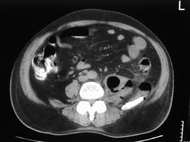 CT scan of a 62-year-old man who reported 2 weeks 