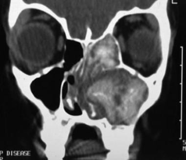 Coronal CT scan showing typical unilateral appeara