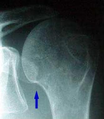 In this patient's shoulder radiography, the humera