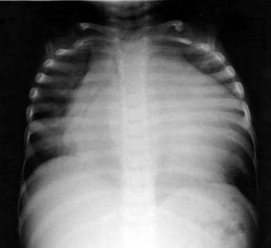 Chest radiograph of a child with idiopathic dilate
