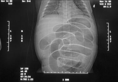 Abdominal radiograph of an infant with acute onset
