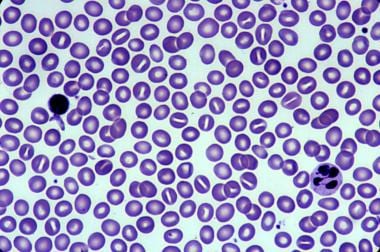 Xerocytosis Image