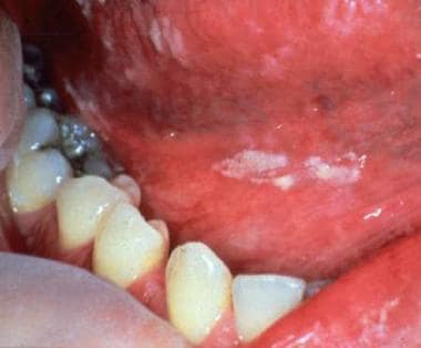 White plaques are present on the buccal mucosa and