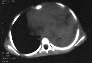 Massive mediastinal T-lymphoblastic lymphoma. Note