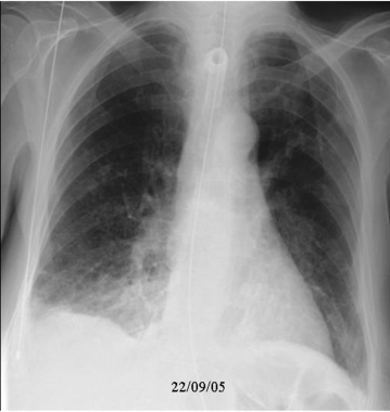 A case of evolving aspiration pneumonia (2 of 4 im