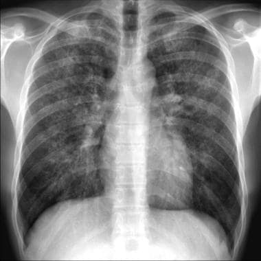 Chest radiograph of HIV-infected patient with PJP 