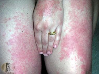 Polymorphous light eruption on the thighs and hand