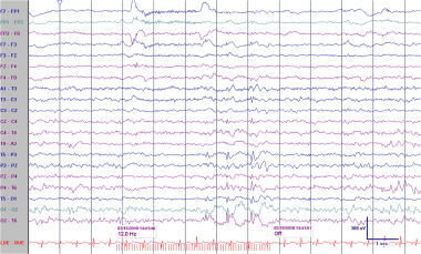 Patient is a 4-year-old boy with seizures. Photic 
