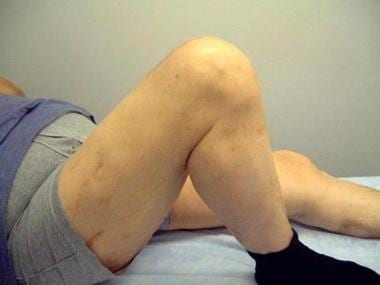 Total knee arthroplasty. Satisfactory knee flexion