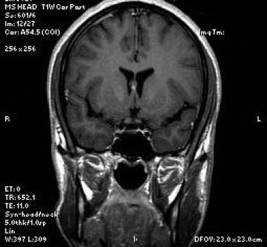 Coronal T1-weighted sequence at the level of the f