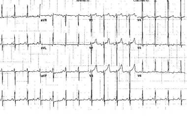 Electrocardiogram from a 47-year-old man with a lo