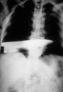 X-ray showing a retained knife blade. 