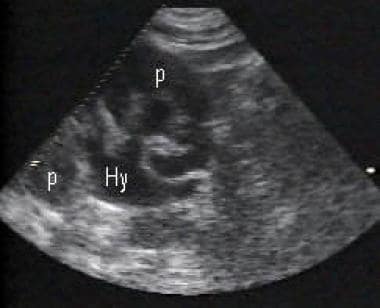 Image demonstrating moderate hydronephrosis (Hy) a