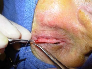 4-0 polyglactin suture is passed through prepared 