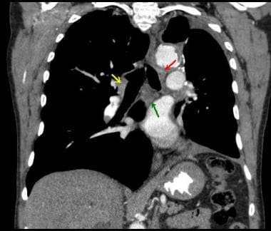 CT scan of chest (coronal view) showing different 