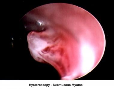 Infertility. Hysteroscopy - Submucous fibroid. Ima