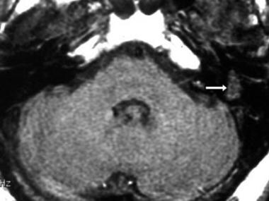 Facial schwannoma. Axial T1-weighted magnetic reso