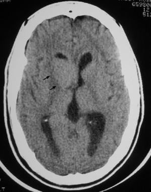 Nonenhanced CT scan of the head on a 56-year-old w