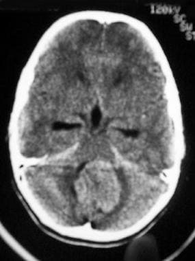 Medulloblastoma. Unenhanced CT shows a high-densit