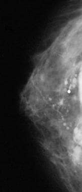 Craniocaudal mammogram shows free extracapsular si