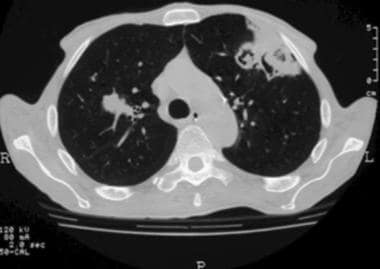 A CT scan showing lung parenchyma involvement with